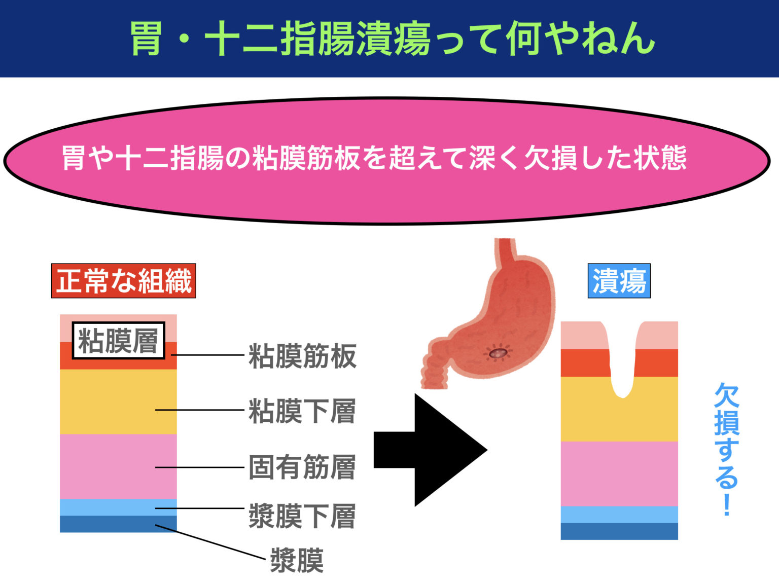 Nsaidsで胃潰瘍になる仕組み！薬の機序をわかりやすく解説！