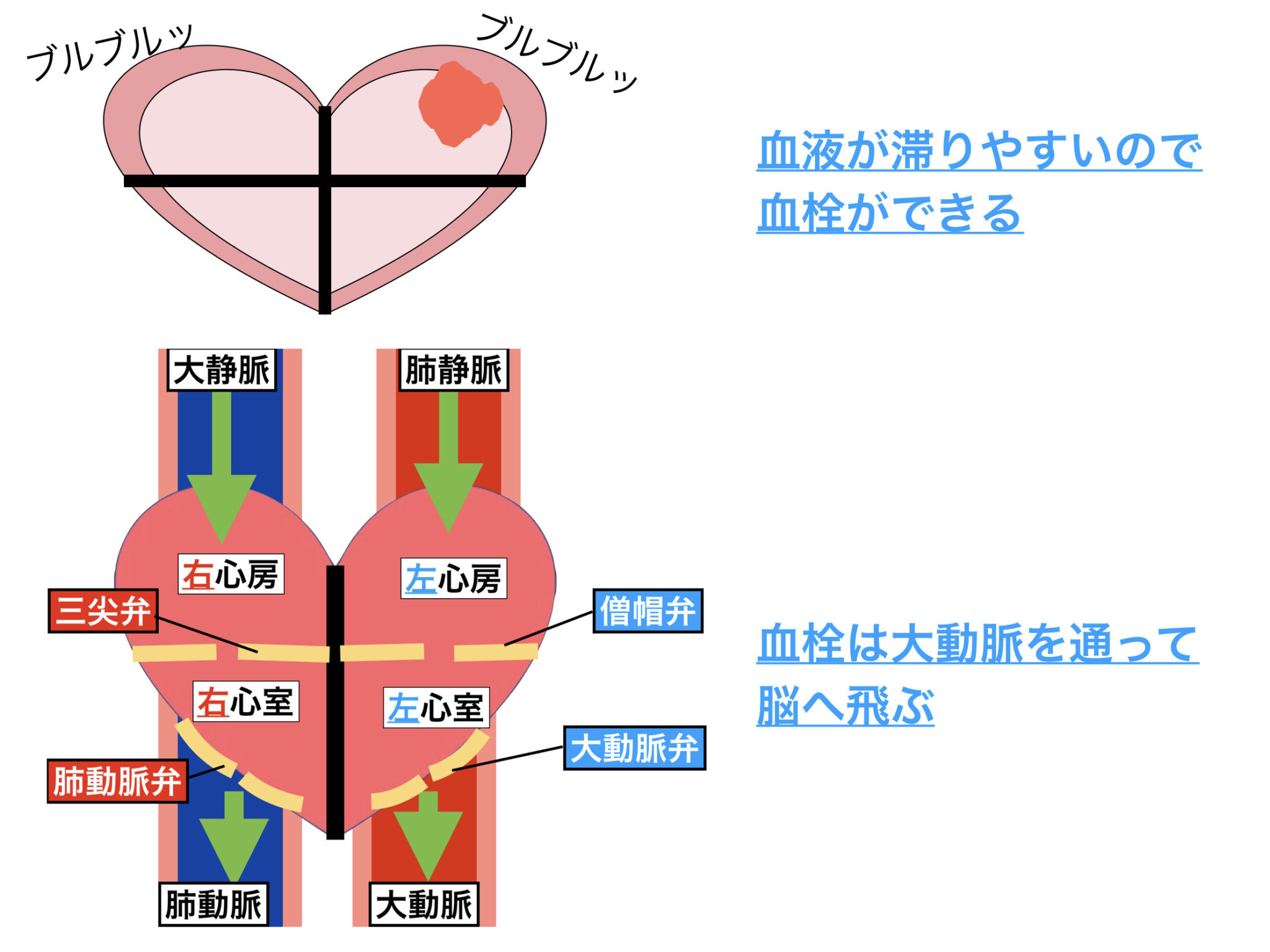 心原性脳梗塞とは？原因や病態をわかりやすく解説！看護師国試に合格！