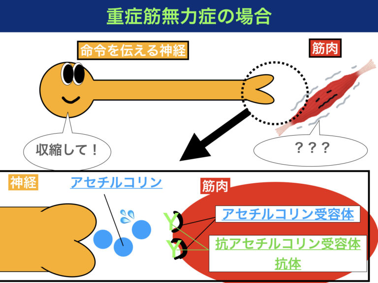 重症筋無力症の病態メカニズムをイラストで解説！複視や嚥下障害などの症状も紹介