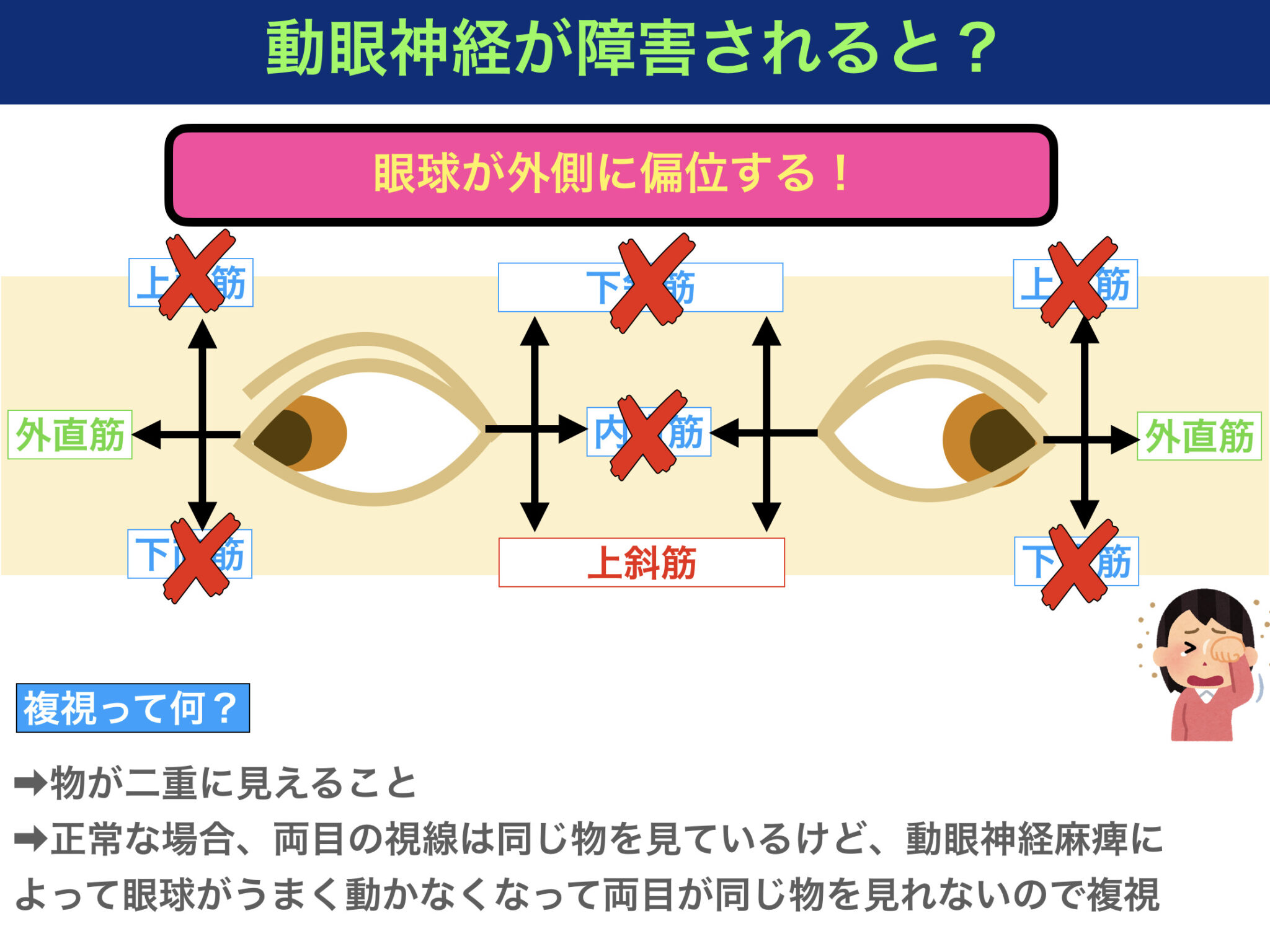 動眼神経の働きとは？〜動眼神経麻痺で眼瞼下垂や散瞳・復視になる仕組みをわかりやすく解説！〜