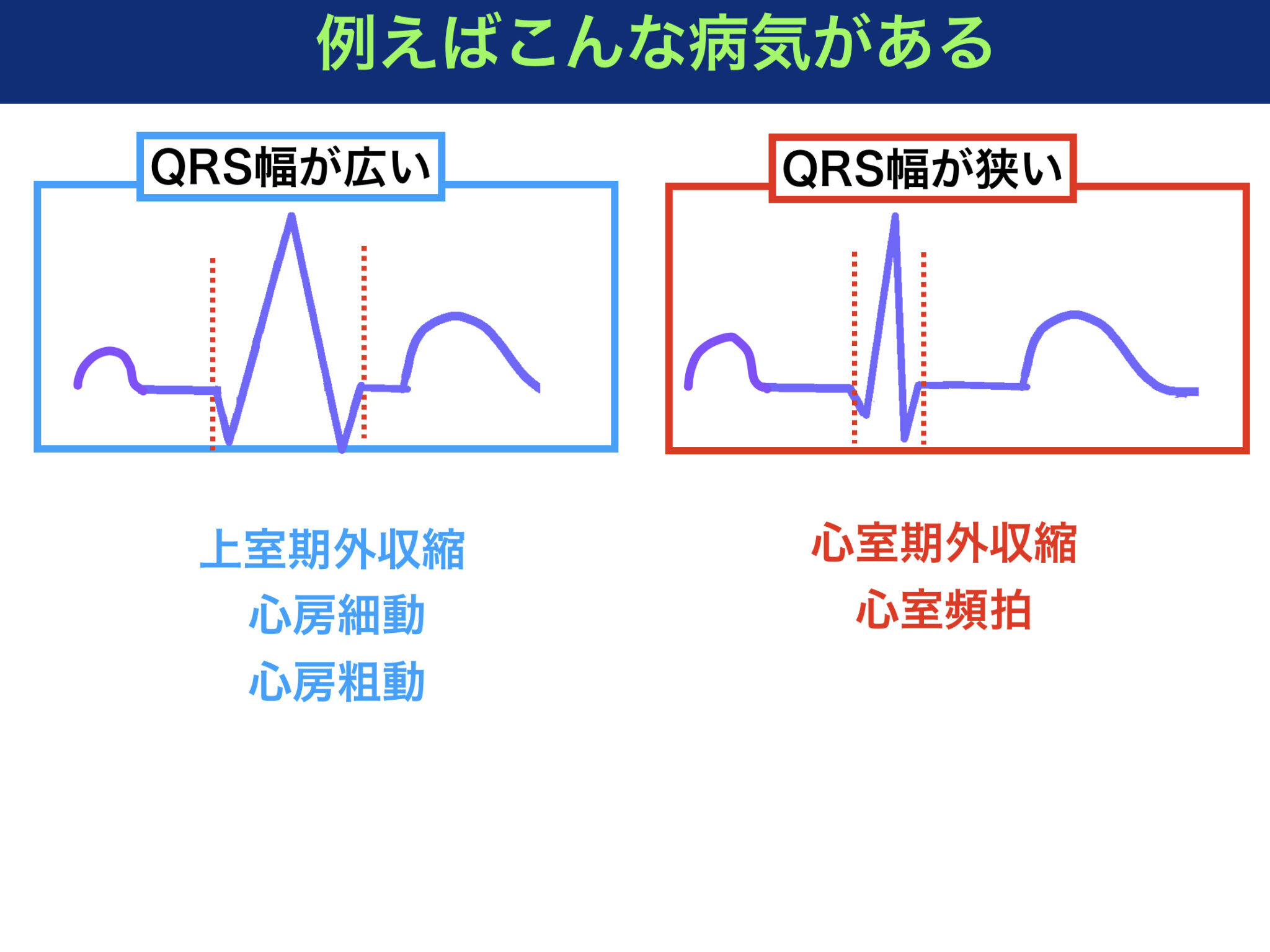 心電図の読み方をわかりやすく解説！QRS波とは？看護師国試に合格