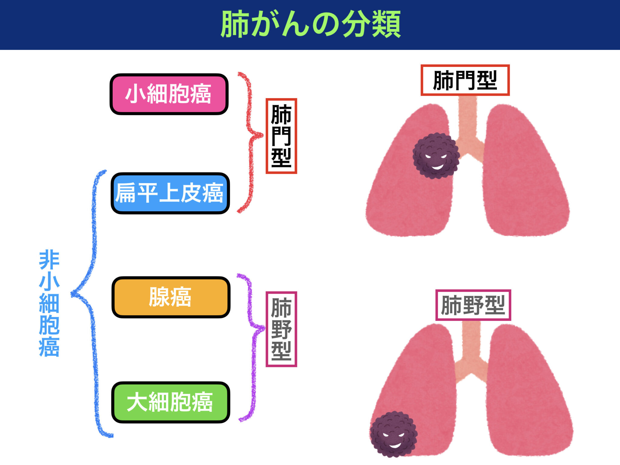 肺がんの症状とは？〜嗄声やパンコースト症候群などの原因を解説！〜